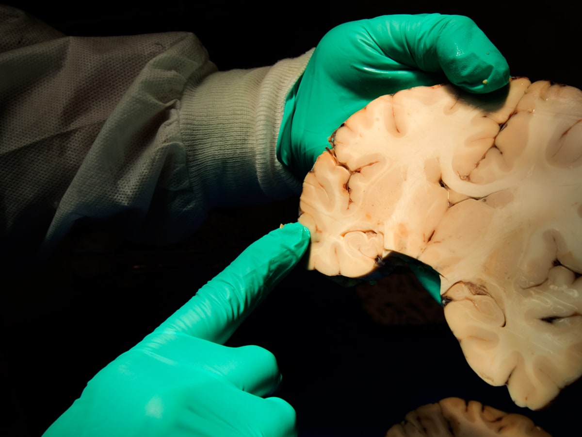 Study: CTE diagnosed in 99% of ex-NFL players studied by researchers