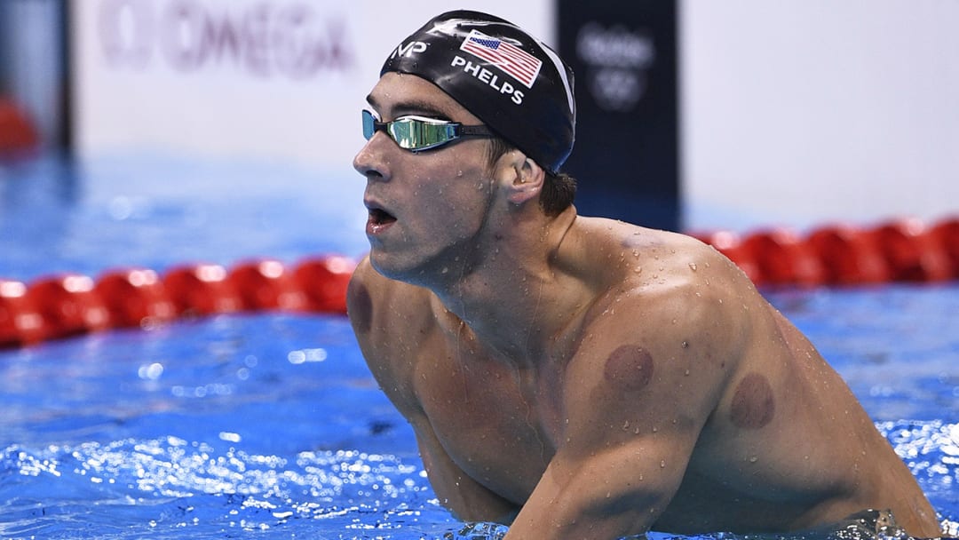 What is cupping? Controversial therapy grabs headlines in Rio