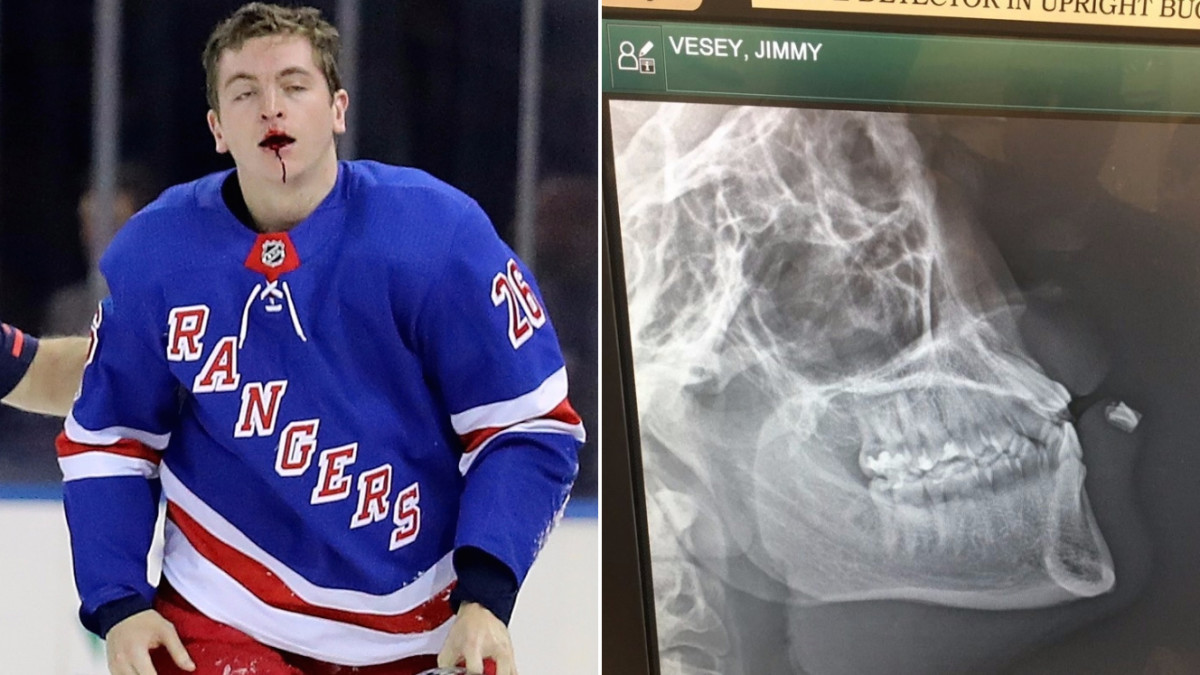 That's hockey': Rangers' Jimmy Vesey gets tooth lodged in lip, plays anyway